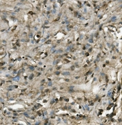 IHC staining of FFPE human meningioma with PRMT8 antibody. HIER: boil tissue sections in pH8 EDTA for 20 min and allow to cool before testing.