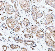 IHC staining of FFPE human breast cancer with PRMT8 antibody. HIER: boil tissue sections in pH8 EDTA for 20 min and allow to cool before testing.