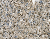 IHC staining of FFPE human meningioma with PRMT8 antibody. HIER: boil tissue sections in pH8 EDTA for 20 min and allow to cool before testing.