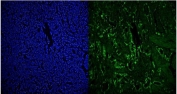 Immunofluorescent staining of FFPE human intestinal cancer with RCC1 antibody (green) and DAPI (blue).