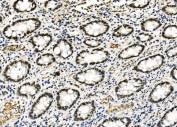 IHC staining of FFPE human rectal cancer with RCC1 antibody. HIER: boil tissue sections in pH8 EDTA for 20 min and allow to cool before testing.