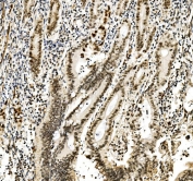 IHC staining of FFPE human rectal cancer with RCC1 antibody. HIER: boil tissue sections in pH8 EDTA for 20 min and allow to cool before testing.