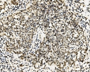 IHC staining of FFPE human lung cancer with RCC1 antibody. HIER: boil tissue sections in pH8 EDTA for 20 min and allow to cool before testing.