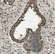 IHC staining of FFPE human breast cancer with RPA32 antibody. HIER: boil tissue sections in pH8 EDTA for 20 min and allow to cool before testing.