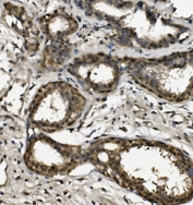 IHC staining of FFPE human breast cancer with RPA32 antibody. HIER: boil tissue sections in pH8 EDTA for 20 min and allow to cool before testing.
