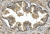 IHC staining of FFPE human prostate cancer with Nogo A antibody. HIER: boil tissue sections in pH8 EDTA for 20 min and allow to cool before testing.