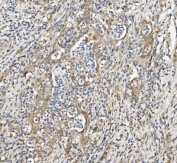 IHC staining of FFPE human rectal cancer with Semaphorin 6A antibody. HIER: boil tissue sections in pH8 EDTA for 20 min and allow to cool before testing.