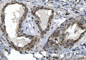 IHC staining of FFPE human breast cancer with SGK1 antibody. HIER: boil tissue sections in pH8 EDTA for 20 min and allow to cool before testing.