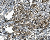 IHC staining of FFPE human breast cancer with SGK1 antibody. HIER: boil tissue sections in pH8 EDTA for 20 min and allow to cool before testing.