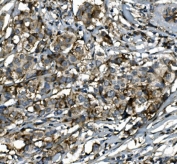 IHC staining of FFPE human breast cancer with SGK1 antibody. HIER: boil tissue sections in pH8 EDTA for 20 min and allow to cool before testing.