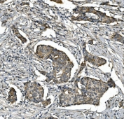 IHC staining of FFPE human breast cancer with STAT6 antibody. HIER: boil tissue sections in pH8 EDTA for 20 min and allow to cool before testing.