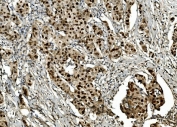 IHC staining of FFPE human breast cancer with Transketolase antibody. HIER: boil tissue sections in pH8 EDTA for 20 min and allow to cool before testing.