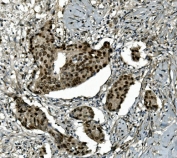 IHC staining of FFPE human breast cancer with Transketolase antibody. HIER: boil tissue sections in pH8 EDTA for 20 min and allow to cool before testing.