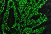 Immunofluorescent staining of FFPE human rectal carcinoma with TRIM28 antibody. HIER: steam section in pH8 EDTA for 20 min.