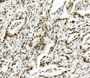 IHC staining of FFPE human rectal cancer with TRIM28 antibody. HIER: boil tissue sections in pH8 EDTA for 20 min and allow to cool before testing.