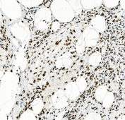 IHC staining of FFPE human rectal cancer with TRIM28 antibody. HIER: boil tissue sections in pH8 EDTA for 20 min and allow to cool before testing.