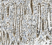 IHC staining of FFPE human rectal cancer with TRIM28 antibody. HIER: boil tissue sections in pH8 EDTA for 20 min and allow to cool before testing.