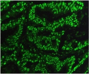 Immunofluorescent staining of FFPE human rectal cancer with TRIM28 antibody (green). HIER: steam section in pH8 EDTA for 20 min.