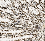 IHC staining of FFPE human rectal cancer with DDX5 antibody. HIER: boil tissue sections in pH8 EDTA for 20 min and allow to cool before testing.