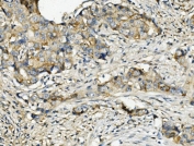 IHC staining of FFPE human breast cancer with RNH1 antibody. HIER: boil tissue sections in pH8 EDTA for 20 min and allow to cool before testing.