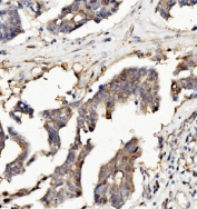 IHC staining of FFPE human ovarian cancer with RNH1 antibody. HIER: boil tissue sections in pH8 EDTA for 20 min and allow to cool before testing.