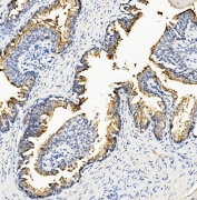 IHC staining of FFPE human prostate cancer with RNH1 antibody. HIER: boil tissue sections in pH8 EDTA for 20 min and allow to cool before testing.