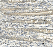 IHC staining of FFPE human rectal cancer with BubR1 antibody. HIER: boil tissue sections in pH8 EDTA for 20 min and allow to cool before testing.