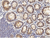 IHC staining of FFPE human rectal cancer with BubR1 antibody. HIER: boil tissue sections in pH8 EDTA for 20 min and allow to cool before testing.