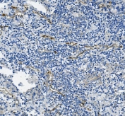 IHC staining of FFPE human lung cancer with PECAM1 antibody. HIER: boil tissue sections in pH8 EDTA for 20 min and allow to cool before testing.