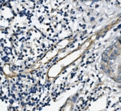 IHC staining of FFPE human breast cancer with PECAM1 antibody. HIER: boil tissue sections in pH8 EDTA for 20 min and allow to cool before testing.