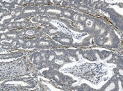 IHC staining of FFPE human rectal cancer with CD146 antibody. HIER: boil tissue sections in pH8 EDTA for 20 min and allow to cool before testing.