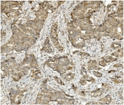 IHC staining of FFPE human breast cancer with MMUT antibody. HIER: boil tissue sections in pH8 EDTA for 20 min and allow to cool before testing.