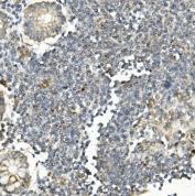 IHC staining of FFPE human rectal cancer with Bid antibody. HIER: boil tissue sections in pH8 EDTA for 20 min and allow to cool before testing.