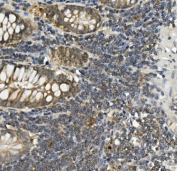 IHC staining of FFPE human rectal cancer with Bid antibody. HIER: boil tissue sections in pH8 EDTA for 20 min and allow to cool before testing.