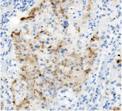 IHC staining of FFPE human lung cancer with ATG4A antibody. HIER: boil tissue sections in pH8 EDTA for 20 min and allow to cool before testing.