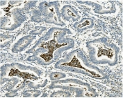 IHC staining of FFPE human rectal cancer with ATG4A antibody. HIER: boil tissue sections in pH8 EDTA for 20 min and allow to cool before testing.