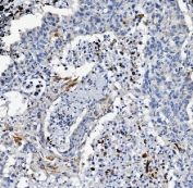 IHC staining of FFPE human lung cancer with ATG7 antibody. HIER: boil tissue sections in pH8 EDTA for 20 min and allow to cool before testing.