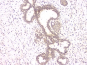 IHC staining of FFPE human breast cancer with ALKBH1 antibody. HIER: boil tissue sections in pH8 EDTA for 20 min and allow to cool before testing.
