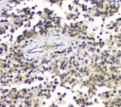 IHC staining of FFPE human testis cancer with ALKBH1 antibody. HIER: boil tissue sections in pH8 EDTA for 20 min and allow to cool before testing.