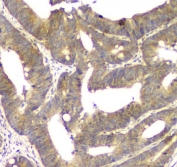 IHC staining of FFPE human intestinal cancer with ALKBH1 antibody. HIER: boil tissue sections in pH8 EDTA for 20 min and allow to cool before testing.