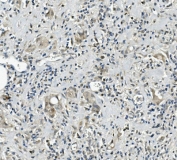 IHC staining of FFPE human rectal cancer with Calbindin 2 antibody. HIER: boil tissue sections in pH8 EDTA for 20 min and allow to cool before testing.
