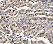 IHC staining of FFPE human rectal cancer with CCNB1 antibody. HIER: boil tissue sections in pH8 EDTA for 20 min and allow to cool before testing.