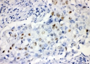 IHC staining of FFPE human lung cancer with CCNE1 antibody. HIER: boil tissue sections in pH8 EDTA for 20 min and allow to cool before testing.