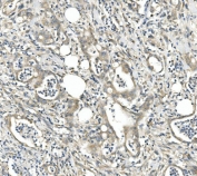 IHC staining of FFPE human rectal cancer with CDR2 antibody. HIER: boil tissue sections in pH8 EDTA for 20 min and allow to cool before testing.
