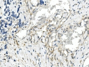 IHC staining of FFPE human lung cancer with CDR2 antibody. HIER: boil tissue sections in pH8 EDTA for 20 min and allow to cool before testing.