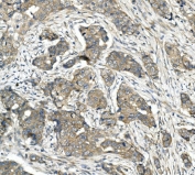 IHC staining of FFPE human breast cancer with CDR2 antibody. HIER: boil tissue sections in pH8 EDTA for 20 min and allow to cool before testing.