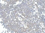 IHC staining of FFPE human lung cancer with CHOP antibody. HIER: boil tissue sections in pH8 EDTA for 20 min and allow to cool before testing.