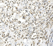 IHC staining of FFPE human B lymphocytic tumor tissue with CHOP antibody. HIER: boil tissue sections in pH8 EDTA for 20 min and allow to cool before testing.