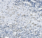 IHC staining of FFPE human lung cancer with RNA Helicase A antibody. HIER: boil tissue sections in pH8 EDTA for 20 min and allow to cool before testing.