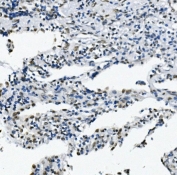 IHC staining of FFPE human lung cancer with RNA Helicase A antibody. HIER: boil tissue sections in pH8 EDTA for 20 min and allow to cool before testing.